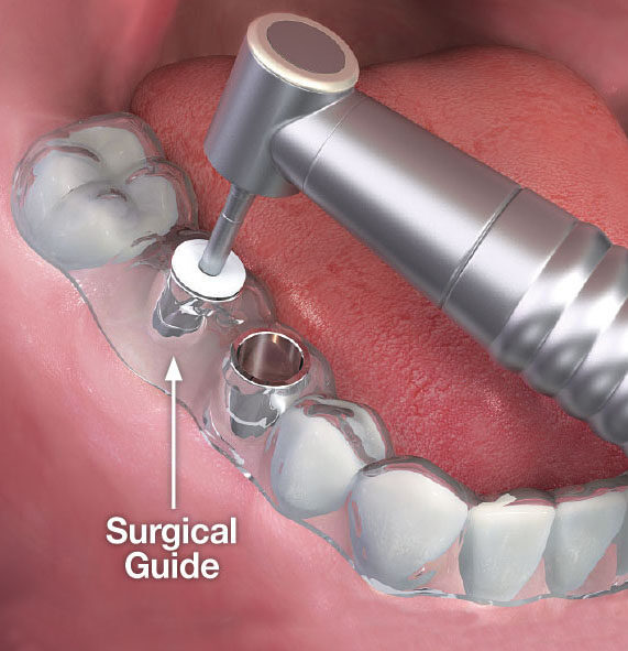  ایمپلنت دیجیتال سرجیکال گاید