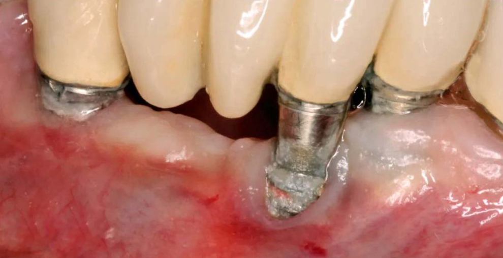 عوارض ایمپلنت بی کیفیت