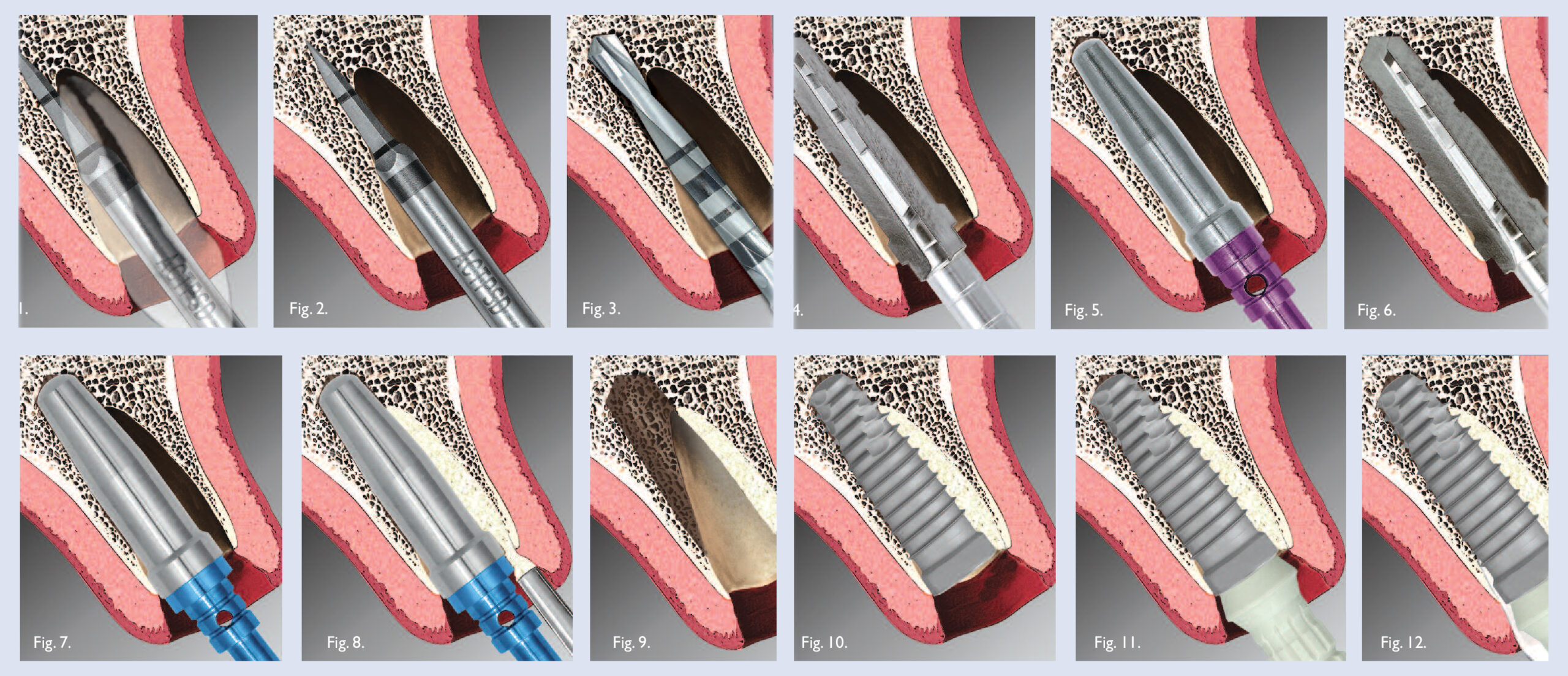 مراحل کاشت ایمپلت فوری دندان