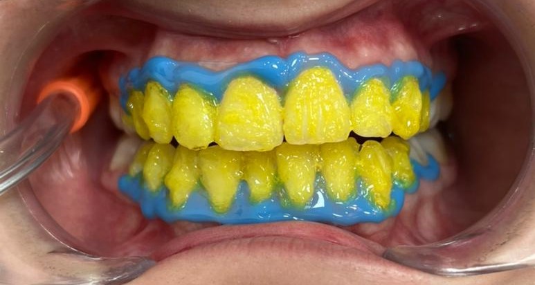 بلیچینگ دندان