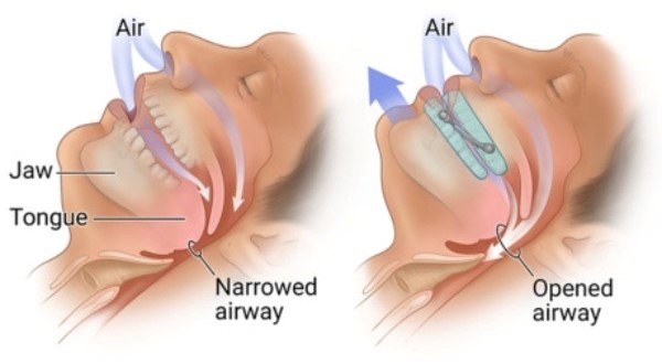 درمان آپنه خواب با گارد دهان