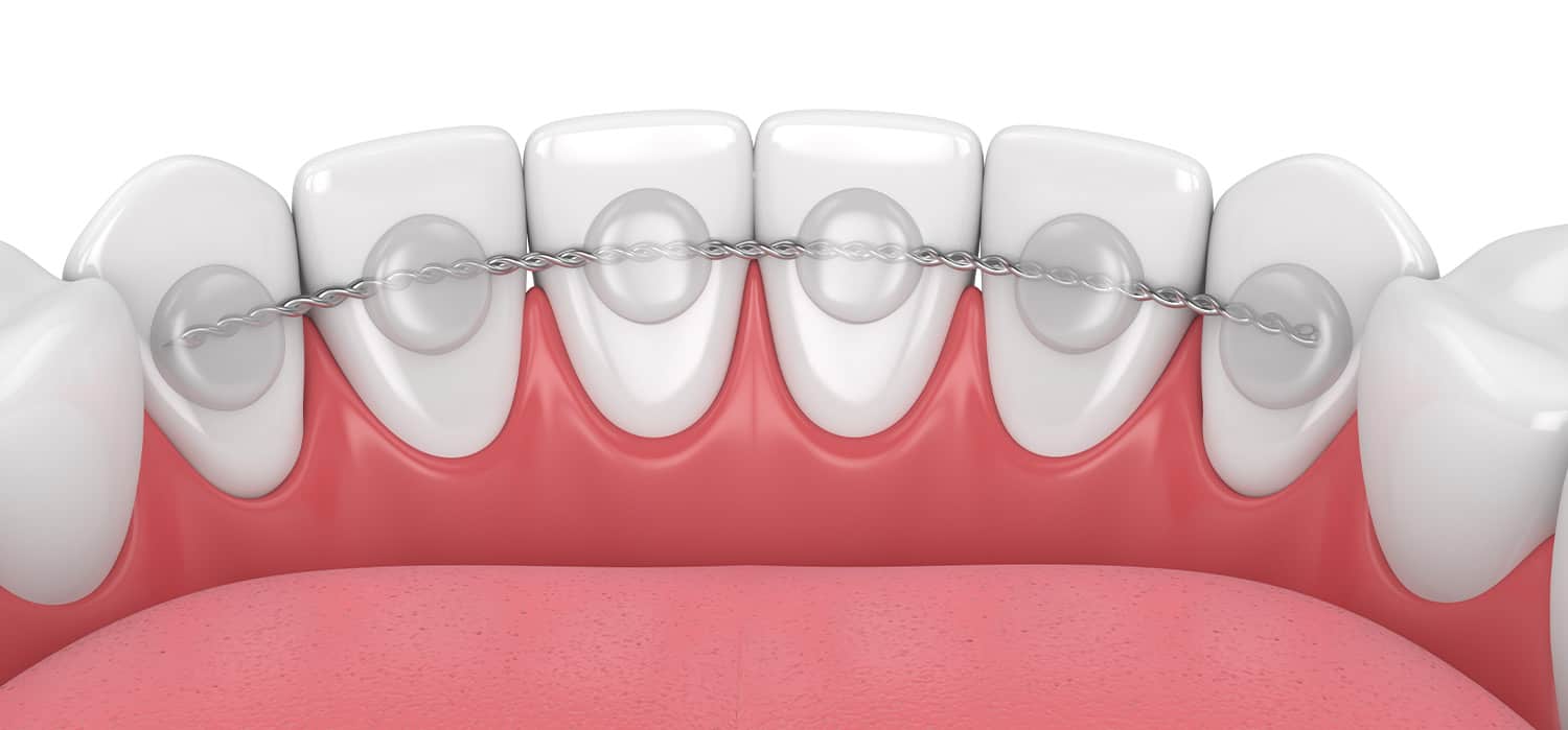 نگهدارنده ارتودنسی ثابت با سیم پشت دندانی