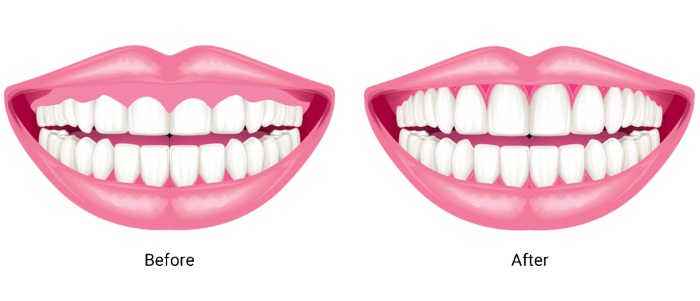 افزایش طول تاج دندان با جراحی لثه