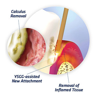 جراحی لثه با لیزر برای حذف پلاک های عمیق دندان