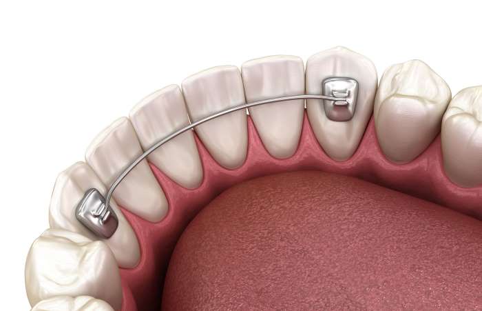 نگهدارنده ارتودنسی ثابت با سیم نازک فیکس شده به چند دندان