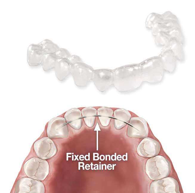 نگهدارنده ثابت ترکیبی، یک نگهدارنده ثابت به همراه یک نگهدارنده متحرک