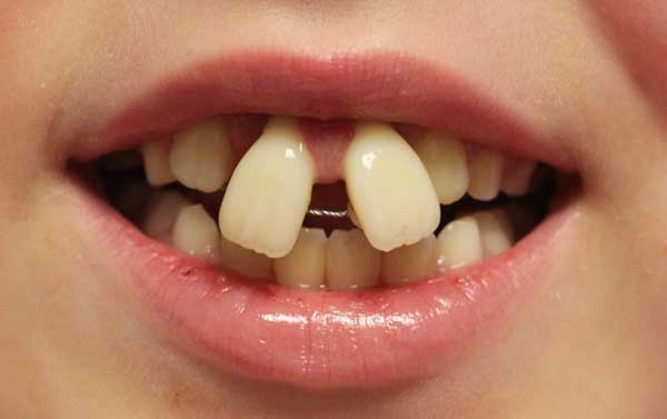 ارتودنسی دندان های خرگوشی