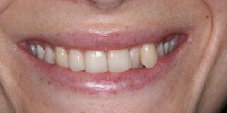 ارتودنسی تک دندان نیش