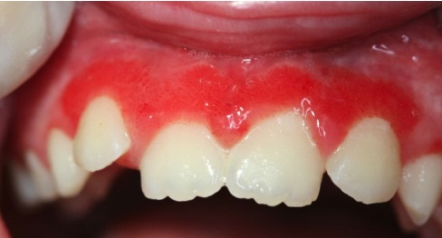 عفونت لثه کودکان