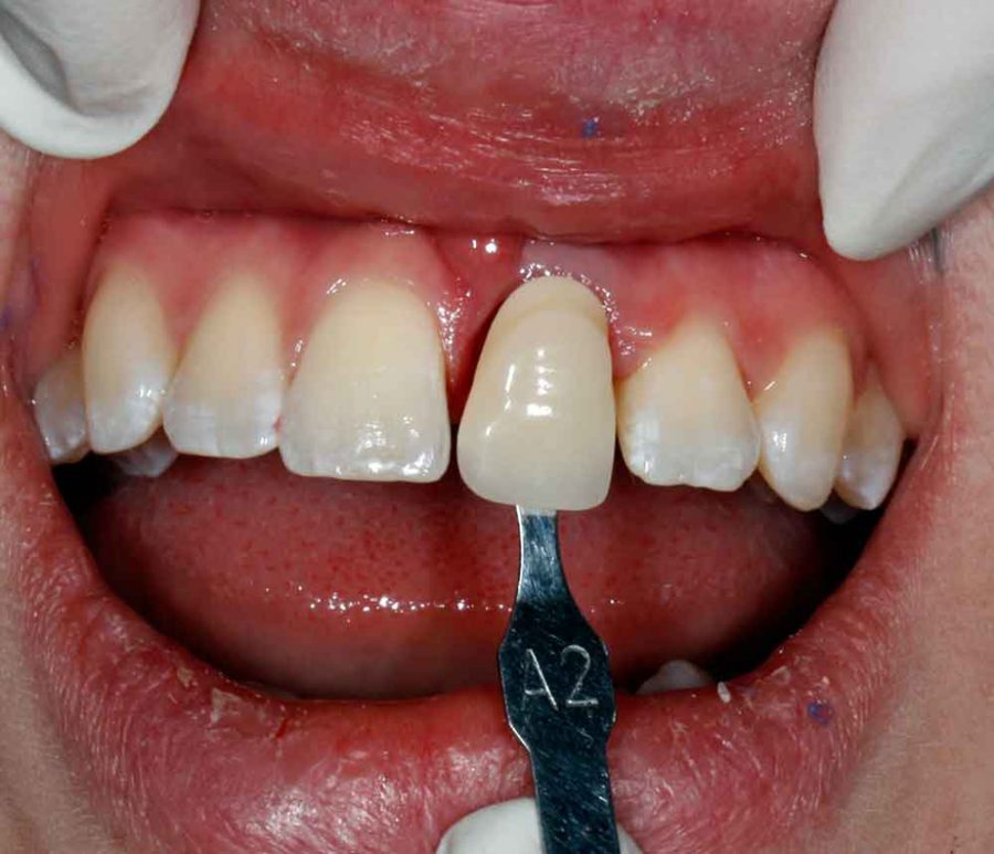 ترمیم دندان