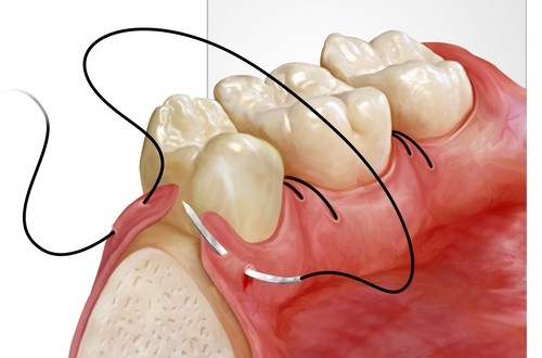 جراحی فلپ لثه در ساری