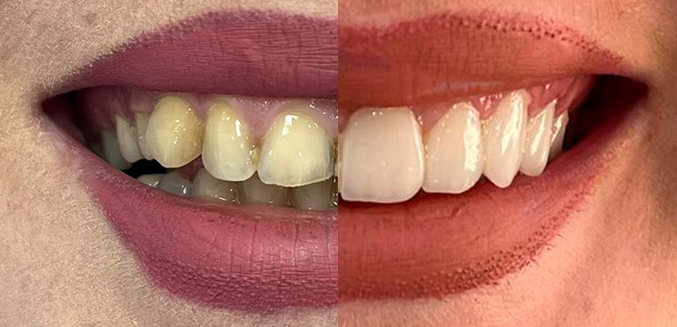 جراحی لیفت لثه در ساری کلینیک دندانپزشکی دکتر شاکریان