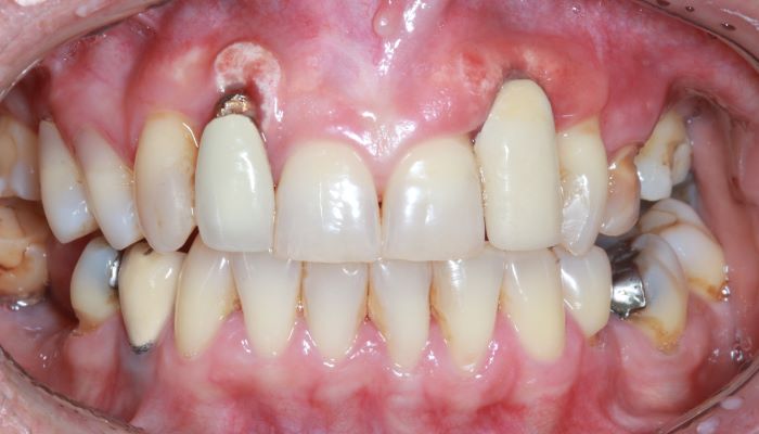 جراحی و کاشت ایمپلنت دندان در ساری