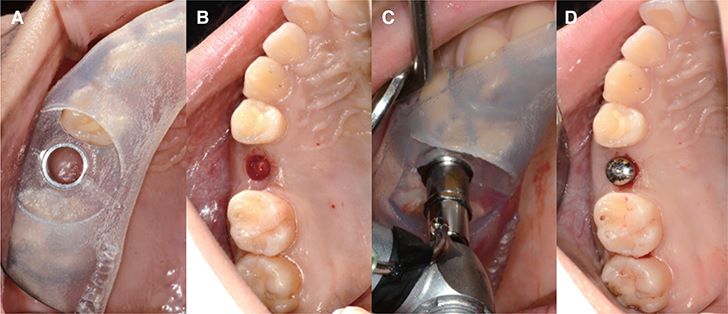 جراحی ایمپلنت در ساری