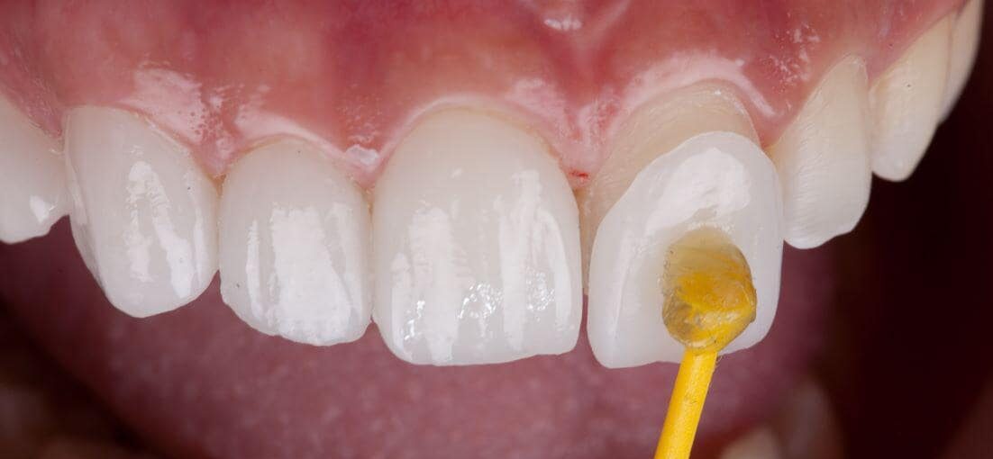 لمینت دندان در ساری