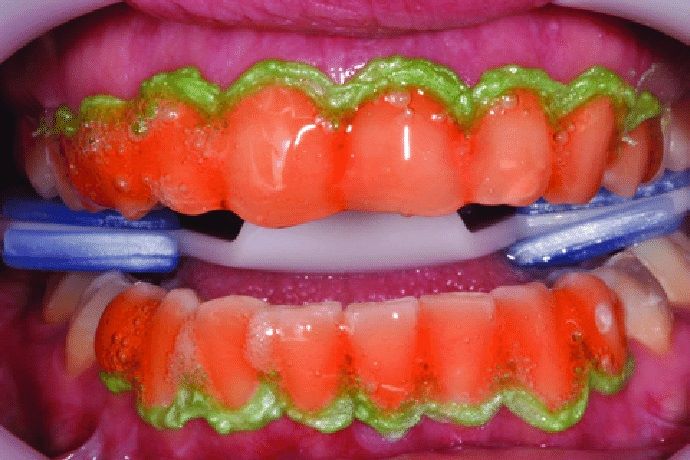 سفید کردن دندان ها