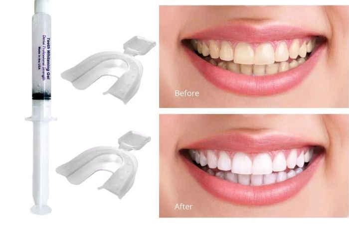 سفید کردن دندان