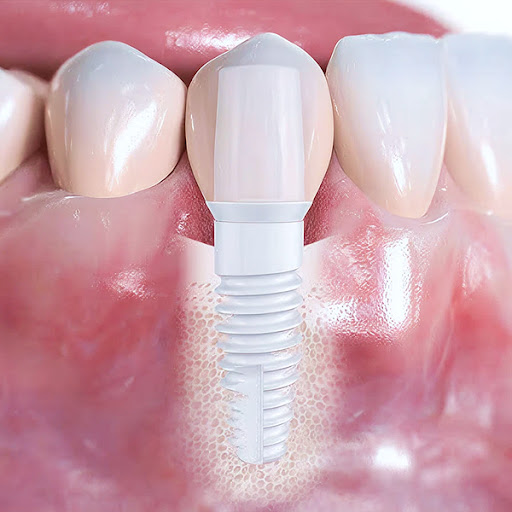 ایمپلنت زیرکونیایی