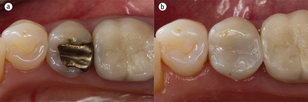 ترمیم دندان در ساری