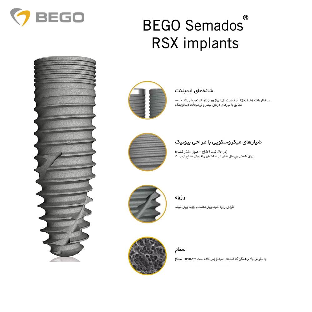 ایمپلنت بگو در ساری