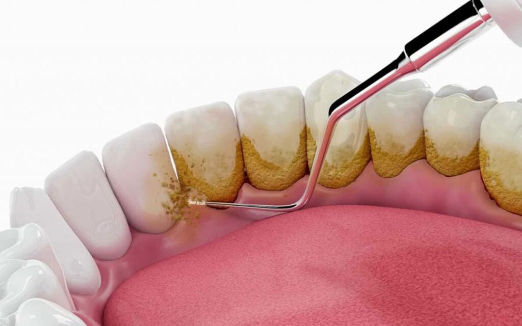 چگونه جرم گیری دندان از پوسیدگی و بیماری لثه جلوگیری میکند؟