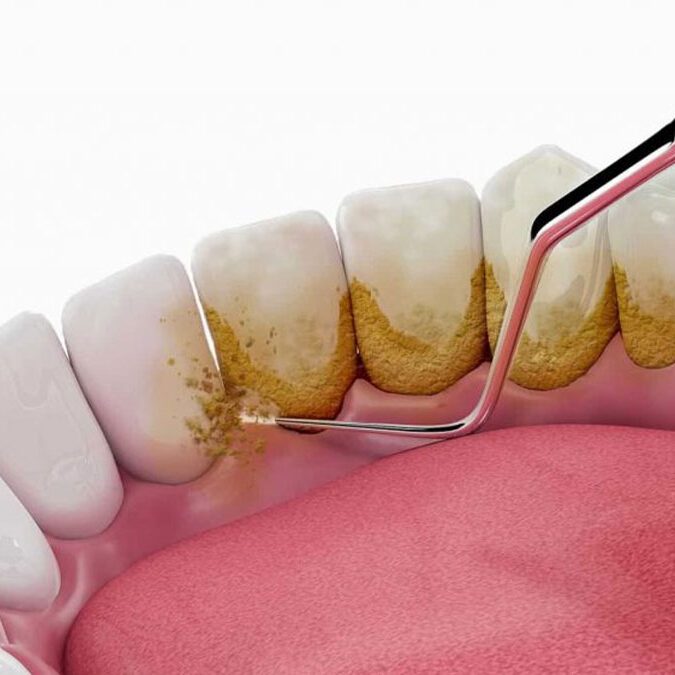 چگونه جرم گیری دندان از پوسیدگی و بیماری لثه جلوگیری می‌کند؟