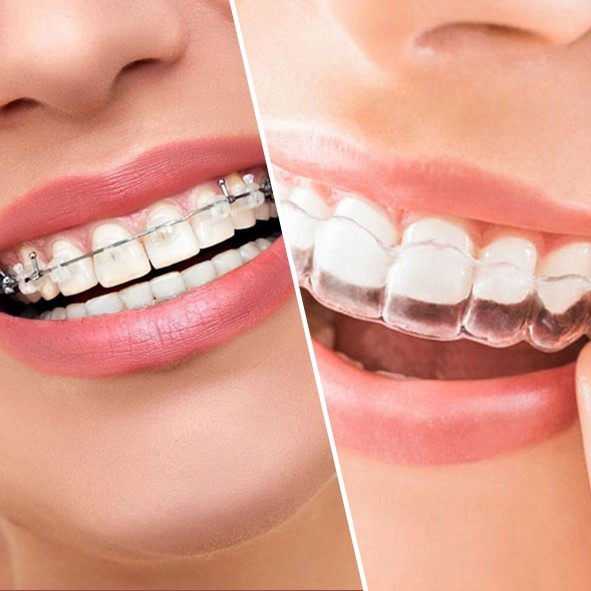 تفاوت ارتودنسی ثابت و متحرک