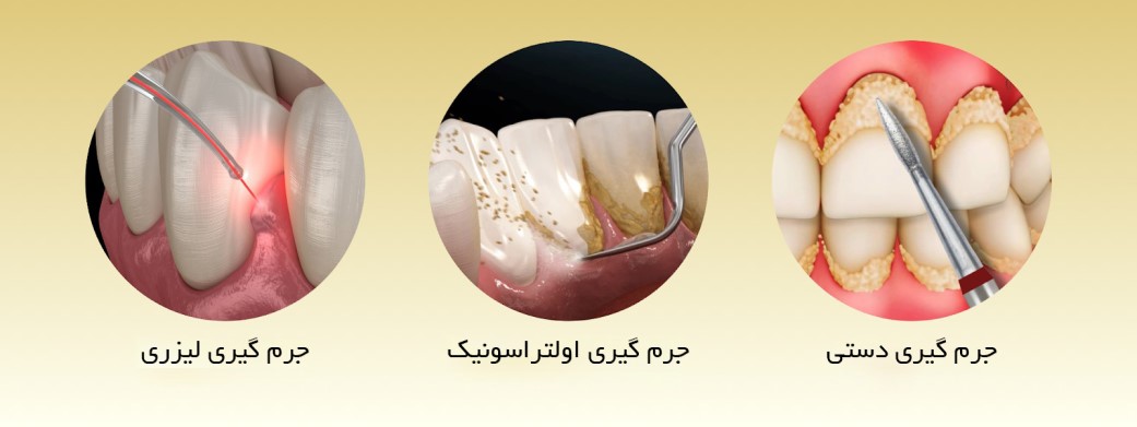 جرم گیری دندان در ساری