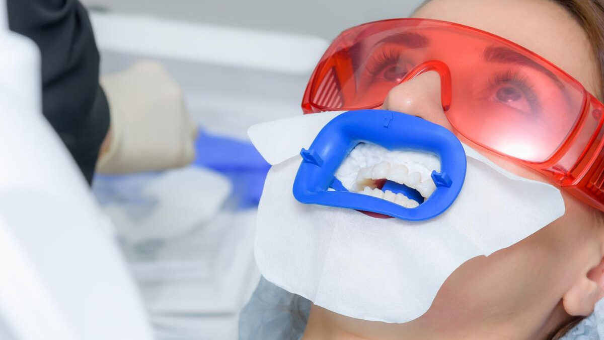 بلیچینگ دندان در ساری