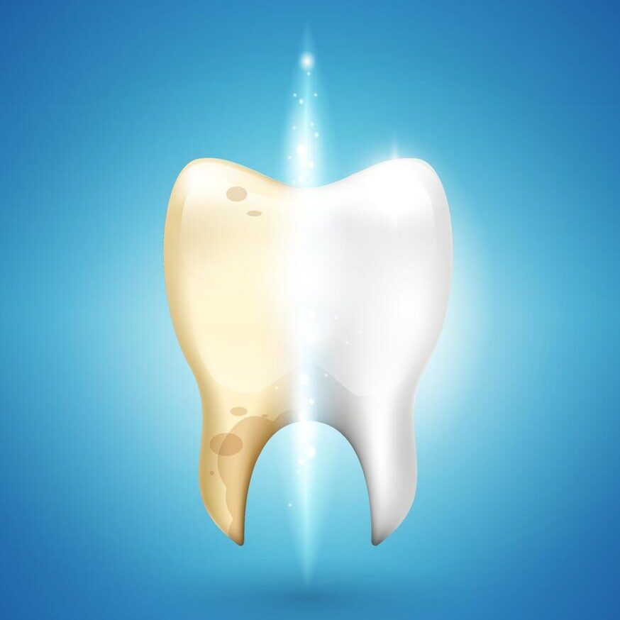 آیا بلیچینگ به مینای دندان آسیب میزند؟