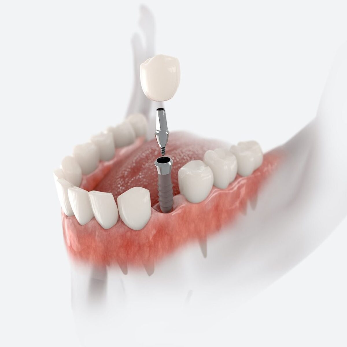 ایمپلنت دیجیتال در یک روز