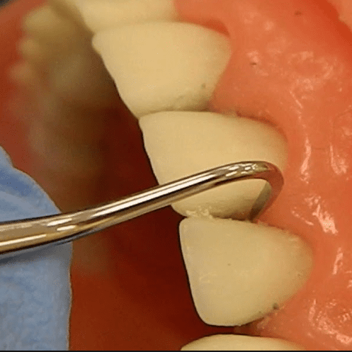 آیا جرم گیری به دندان‌ آسیب می‌رساند؟