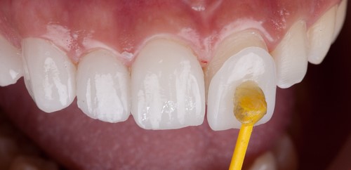 لمینت دندان