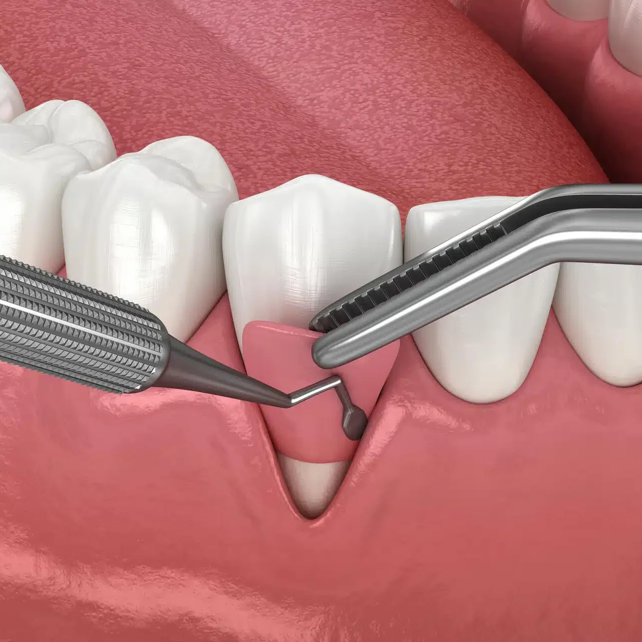 چه کسانی به جراحی لثه نیاز دارند؟