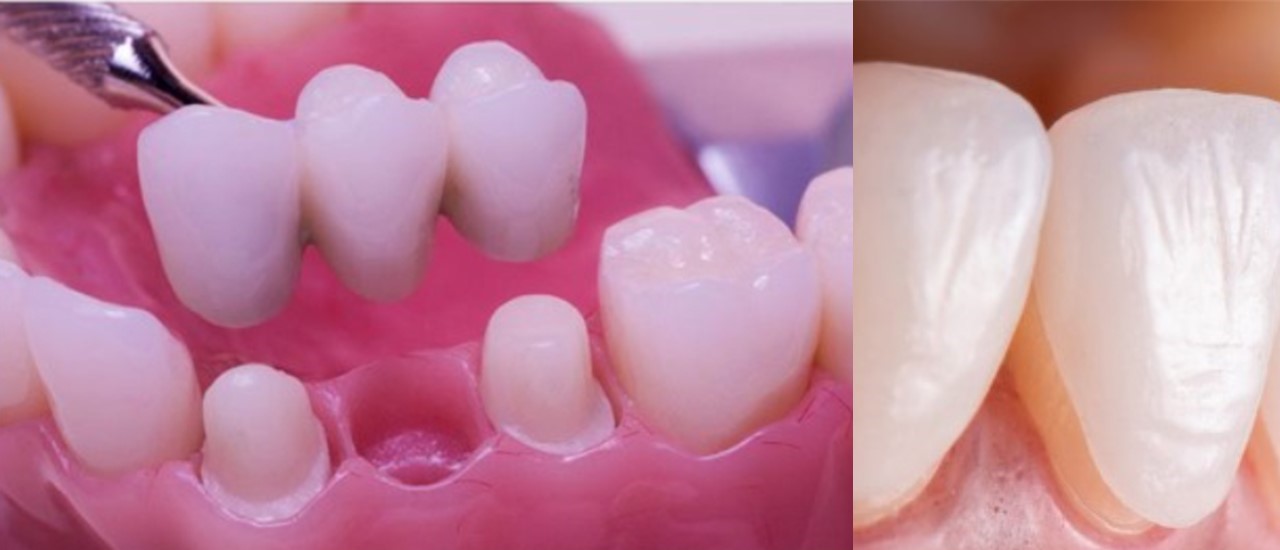 تفاوت لمینت دندان با روکش