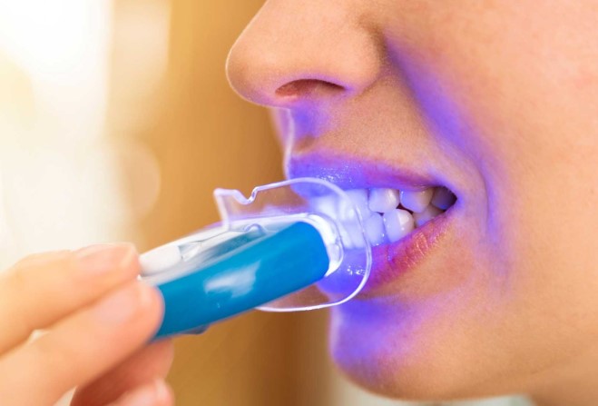سفید کردن دندان با لیزر