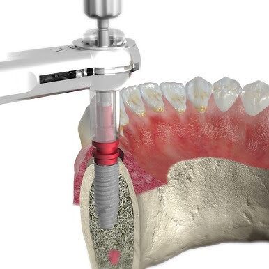چرا ایمپلنت دیجیتال دقت بالاتری دارد؟