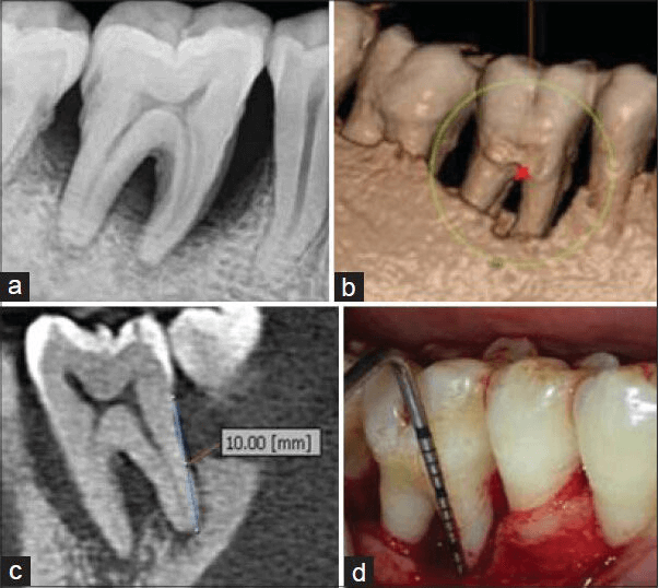 تصویربرداری برای تشخیص بیماری های لثه