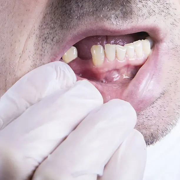 چه کسانی کاندید مناسب کاشت ایمپلنت دندان هستند؟