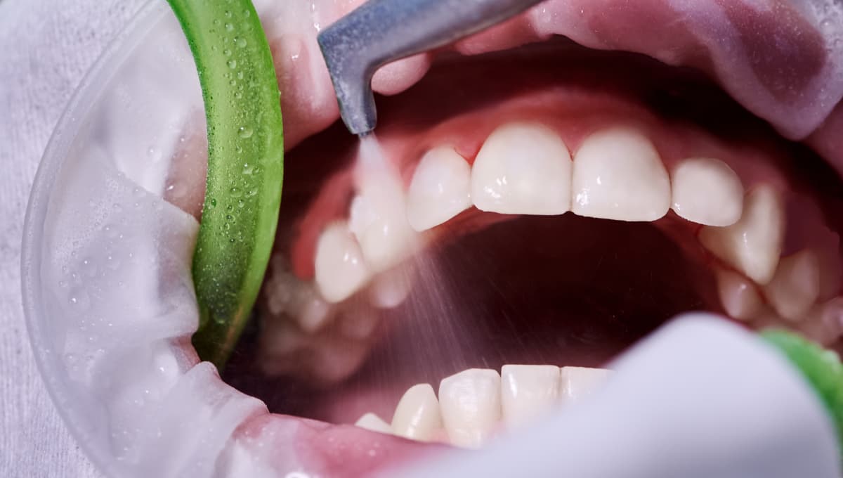 جرم گیری دندان