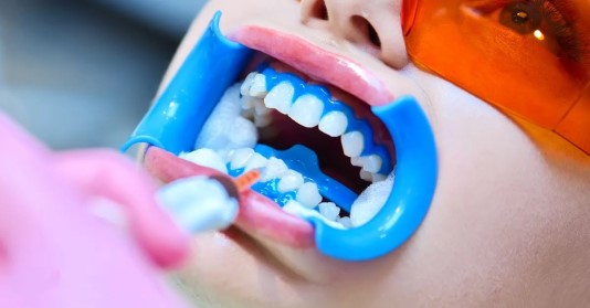 بلیچینگ دندان