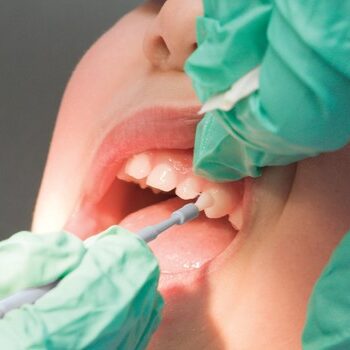 فلورایدتراپی دندان کودکان