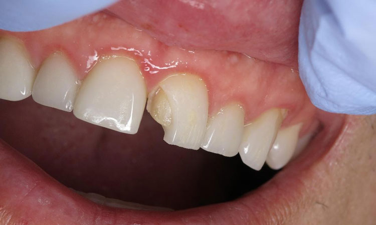 تعویض لمینت دندان