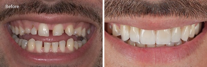 درمان فاصله دندان