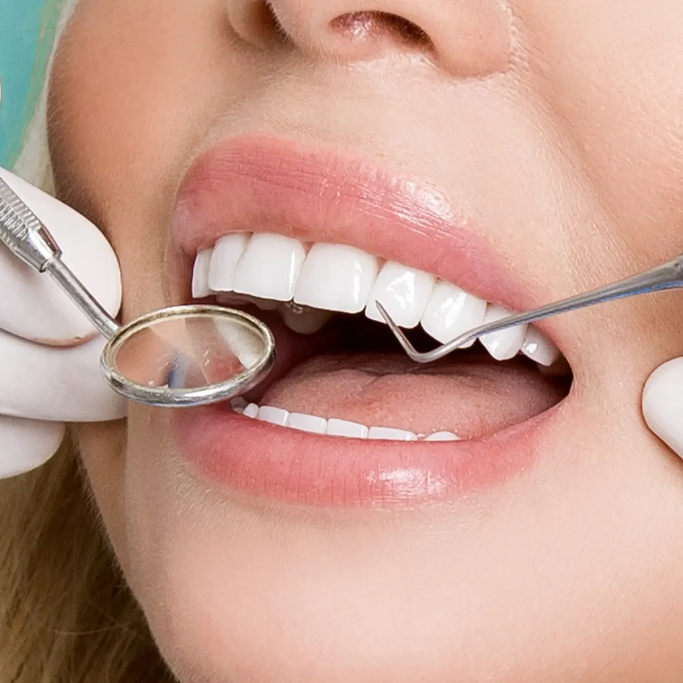 اصلاح طرح لبخند بدون تراش دندان