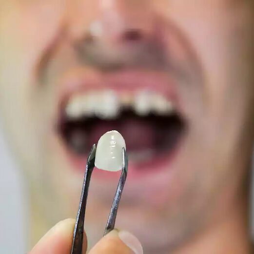 امکان ترمیم یا تعویض لمینت دندان وجود دارد؟