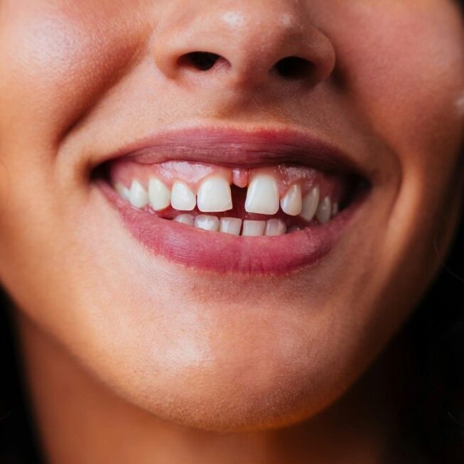 درمان فاصله دندان بدون ارتودنسی