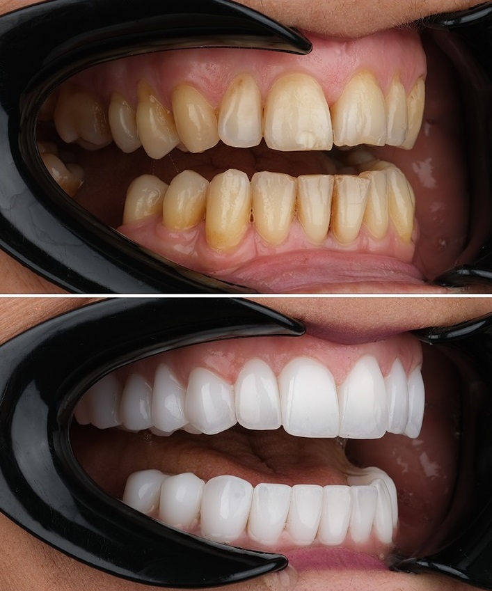 اصلاح طرح لبخند