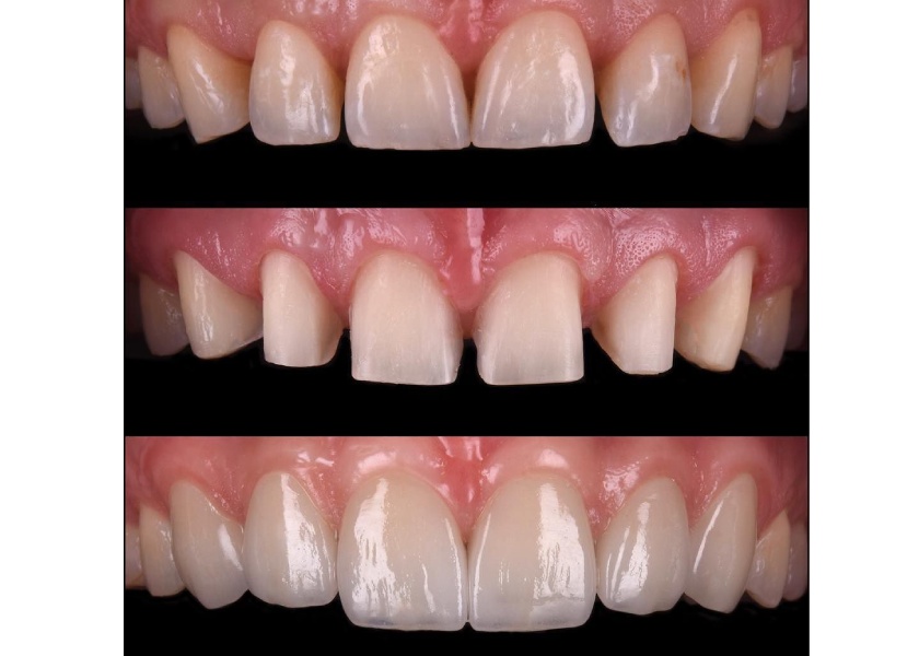 درمان دیاستم بدون ارتودنسی