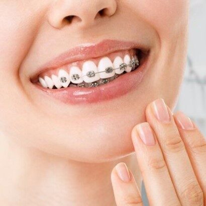 مدت زمان ارتودنسی دندان چقدر است؟
